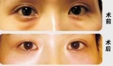 滄州眼苔再造價格