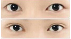廊坊雙眼皮價格