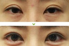 運城上瞼松弛矯正術價格