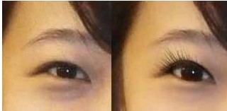 運(yùn)城去黑眼圈價(jià)格