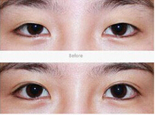廊坊水泡眼矯正價(jià)格