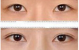 廊坊眼瞼缺損局部皮瓣修復價格