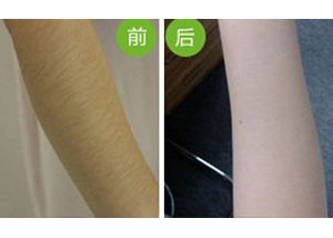 保定前臂脫毛價格