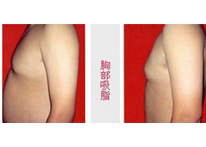 保定胸部吸脂價(jià)格