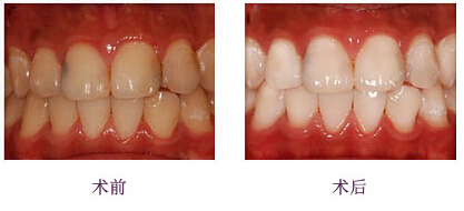 福州名韓冷光美白牙齒的適應(yīng)癥有哪些