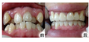 忻州牙齒矯正價(jià)格
