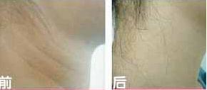 承德頸部除皺價格