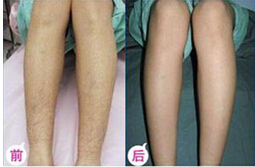 廊坊大小腿脫毛價(jià)格