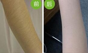 滄州手臂脫毛價格