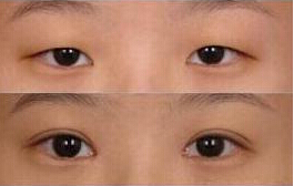 臨汾眼瞼下垂矯正價格