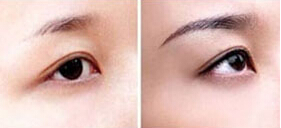 長(zhǎng)治紋眉價(jià)格