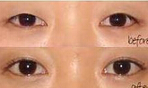 臨汾瞼眶溝填充價格