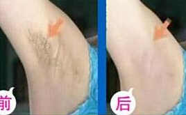 運(yùn)城激光脫腋毛價(jià)格