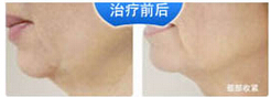 廊坊射頻美容價(jià)格