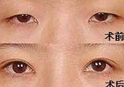 臨汾眼部綜合術價格