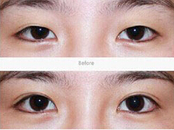 臨汾水泡眼矯正價格