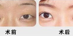 臨汾眼瞼缺損局部皮瓣修復價格