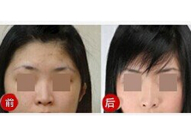 晉城上瞼松弛矯正價格