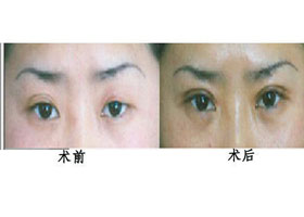晉城三角眼矯正價格