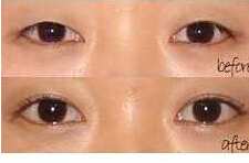 朔州眼瞼病損切除術(shù)價格