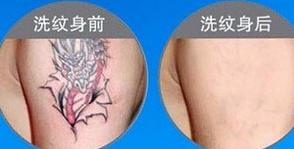 滄州洗紋身價(jià)格