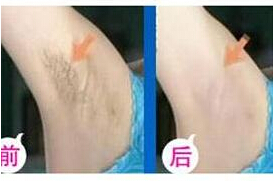 淄博脫腋毛價(jià)格