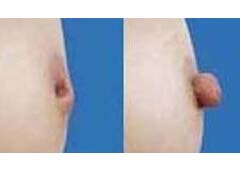 晉城乳頭內(nèi)陷矯正價(jià)格
