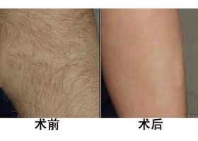 晉城手臂脫毛價(jià)格