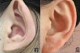 運城杯狀耳矯正價格