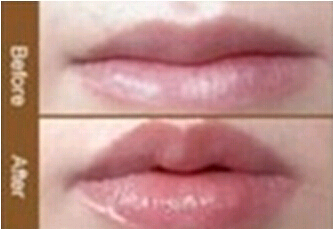 長(zhǎng)治重唇整形價(jià)格