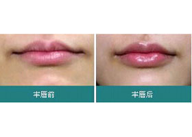 淄博薄唇增厚價(jià)格