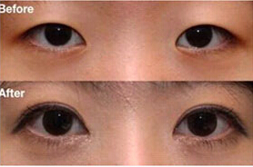 昭通雙眼皮價格