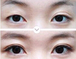 昭通雙眼皮失敗修復(fù)價格