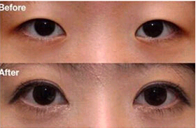 晉中雙眼皮價格