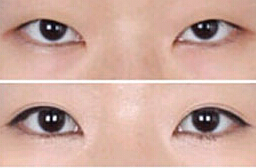 呂梁雙眼皮價格