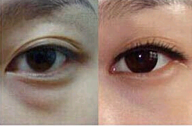 晉中祛眼袋價格