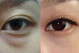 呂梁祛眼袋價格