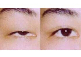 呂梁眼瞼下垂矯正價格