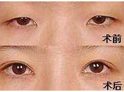 昭通眼部綜合術(shù)價格