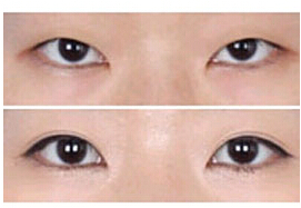 大理雙眼皮價格