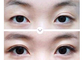 大理雙眼皮失敗修復(fù)價(jià)格
