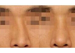 大理歪鼻整形價(jià)格
