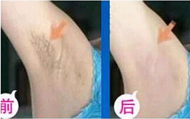 晉中激光脫腋毛價格