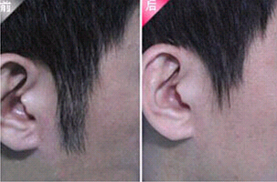 晉中發際線脫毛價格