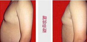 臨汾胸部吸脂價(jià)格
