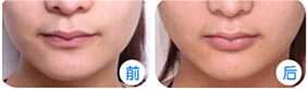 臨汾薄唇增厚價(jià)格