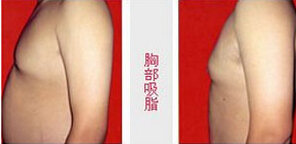 昭通胸部吸脂價格