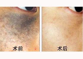大理點(diǎn)痣價(jià)格