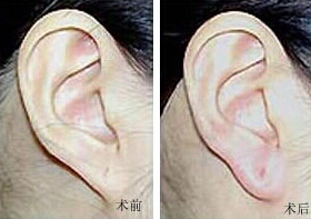 大理耳垂加大價格