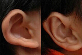 昭通耳垂再造價格